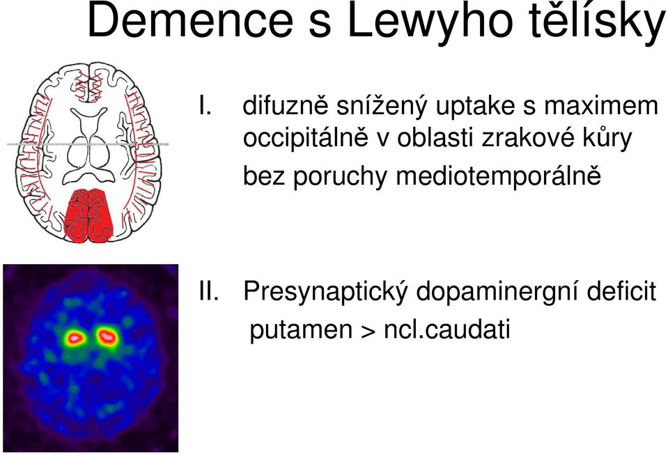 v oblasti zrakové kůry bez poruchy