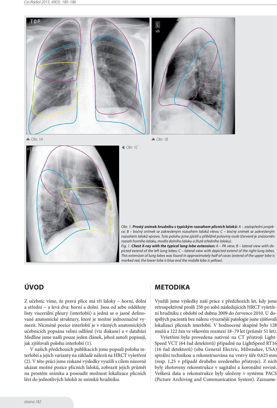 Chest X-ray with the typical lung lobe extension: A PA view; B lateral view with depicted extend of the left lung lobes; C lateral view with depicted extend of the right lung lobes.