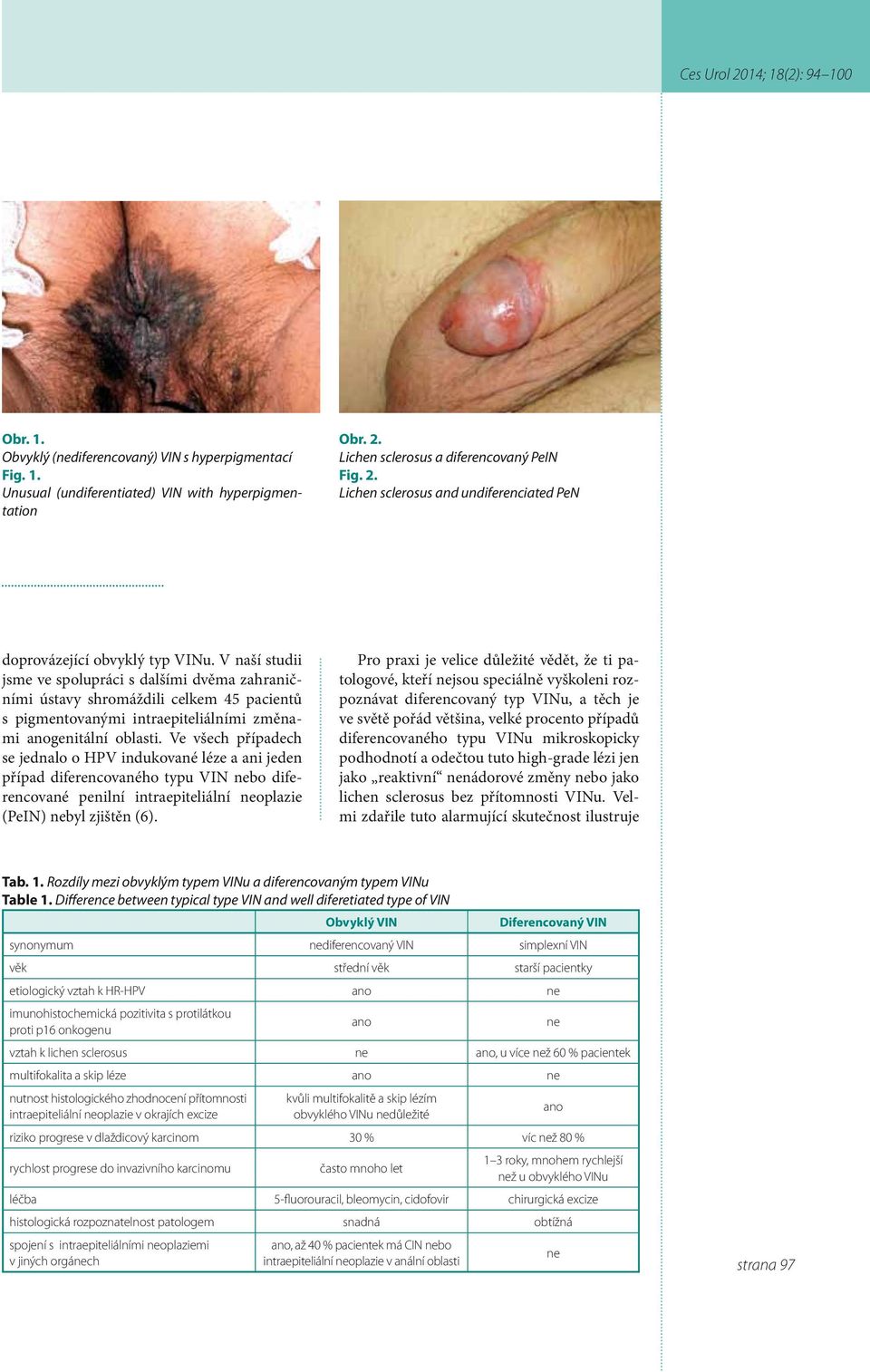 Ve všech případech se jednalo o HPV indukované léze a ani jeden případ diferencovaného typu VIN bo diferencované penilní intraepiteliální oplazie (PeIN) byl zjištěn (6).