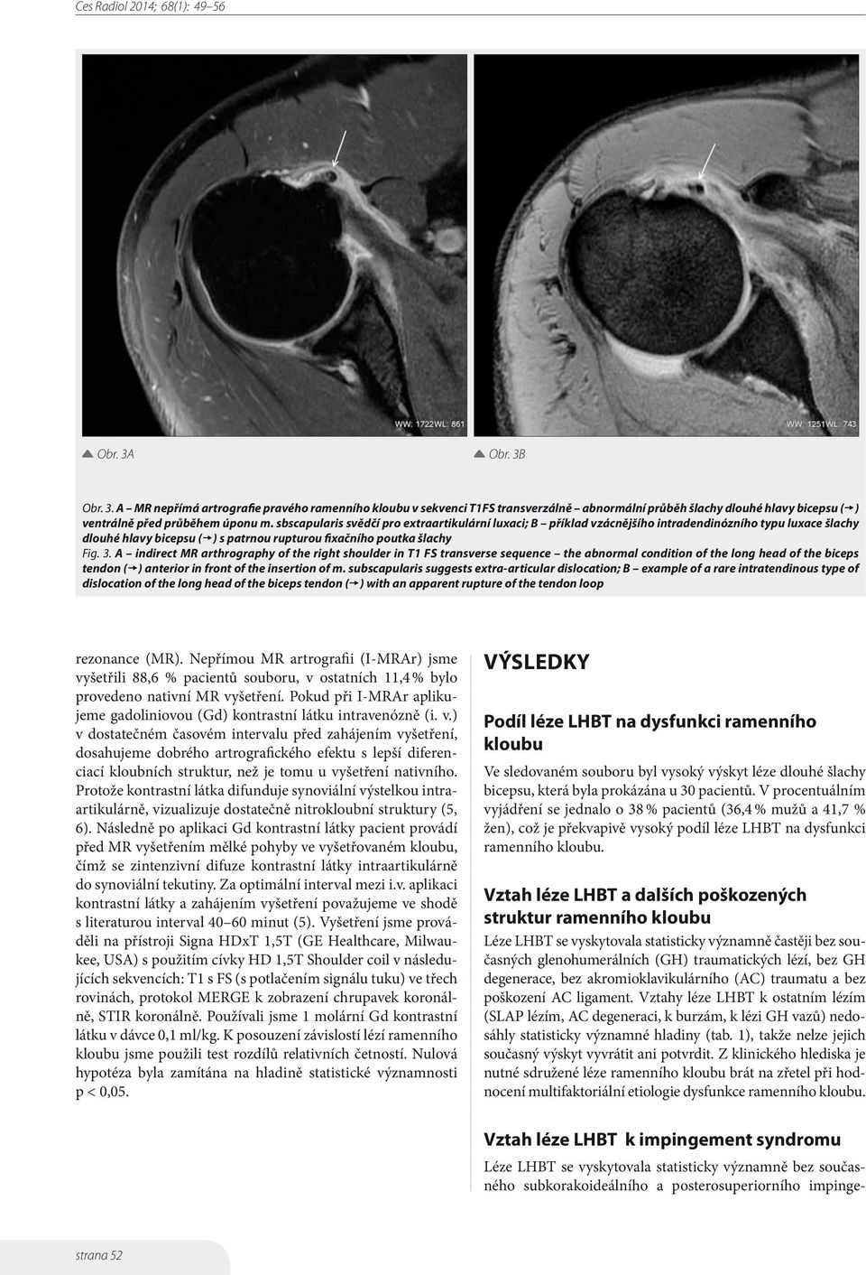 A indirect MR arthrography of the right shoulder in T1 FS transverse sequence the abnormal condition of the long head of the biceps tendon ( ) anterior in front of the insertion of m.