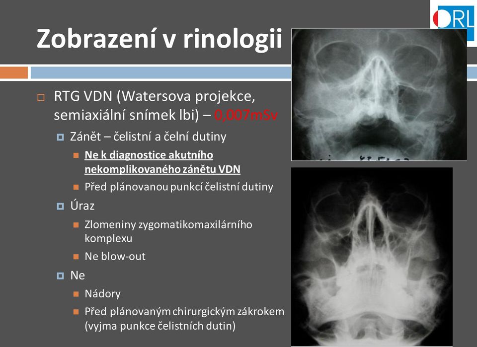 Před plánovanou punkcí čelistní dutiny Úraz Ne Zlomeniny zygomatikomaxilárního