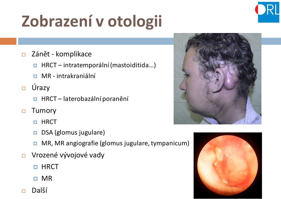 poranění Tumory HRCT DSA (glomus jugulare) MR, MR angiografie