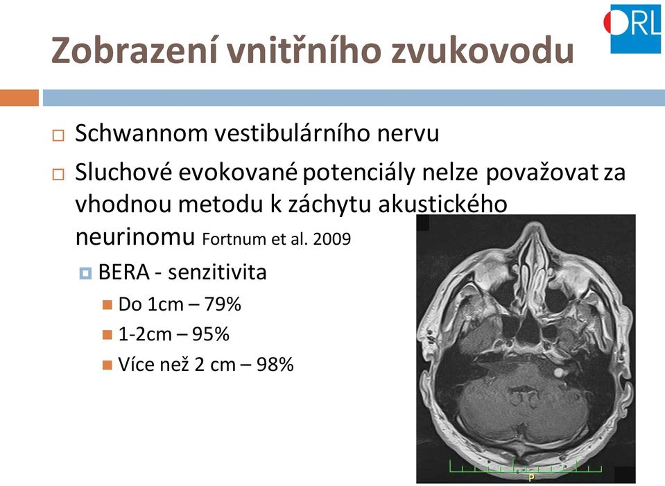 vhodnou metodu k záchytu akustického neurinomu Fortnum et