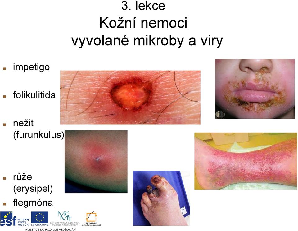 impetigo folikulitida nežit