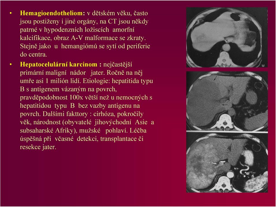 Etiologie: hepatitida typu B s antigenem vázaným na povrch, pravděpodobnost 100x větší než u nemocných s hepatitidou typu B bez vazby antigenu na povrch.