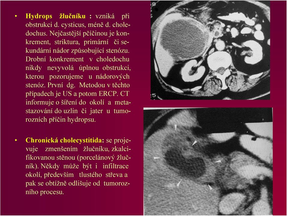 Drobní konkrement v choledochu nikdy nevyvolá úplnou obstrukci, kterou pozorujeme u nádorových stenóz. První dg. Metodou v těchto případech je US a potom ERCP.