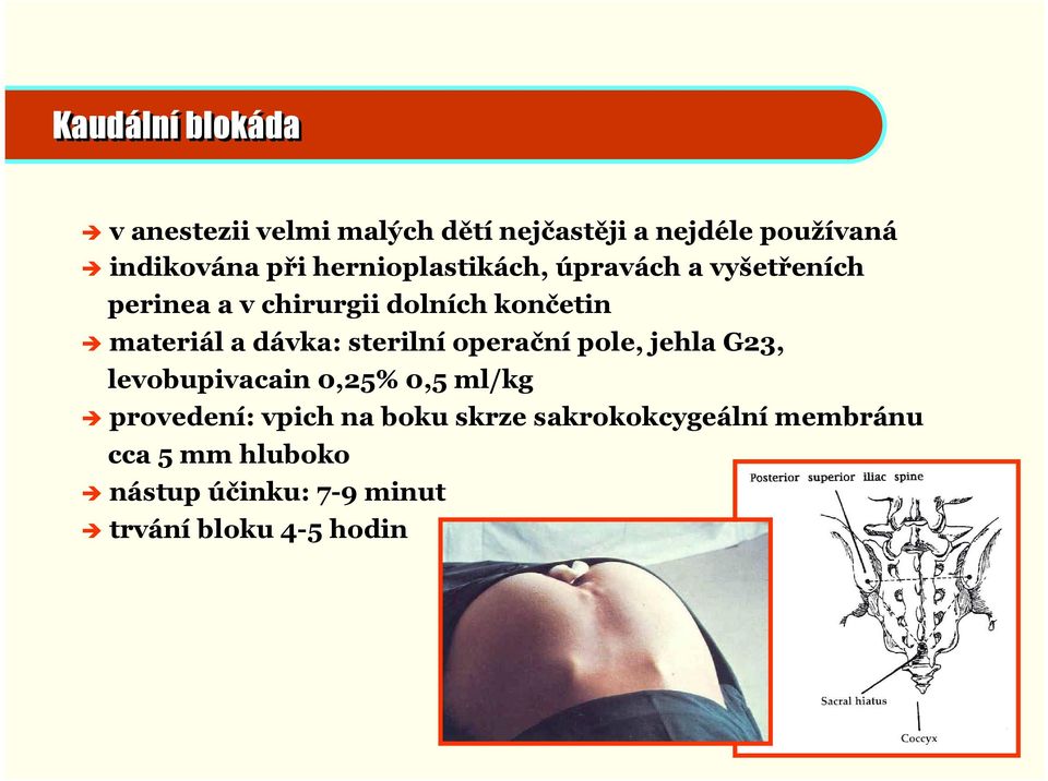 dávka: sterilní operační pole, jehla G23, levobupivacain 0,25% 0,5 ml/kg provedení: vpich na