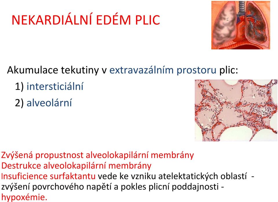 Destrukce alveolokapilární membrány lnsuficience surfaktantu vede ke vzniku