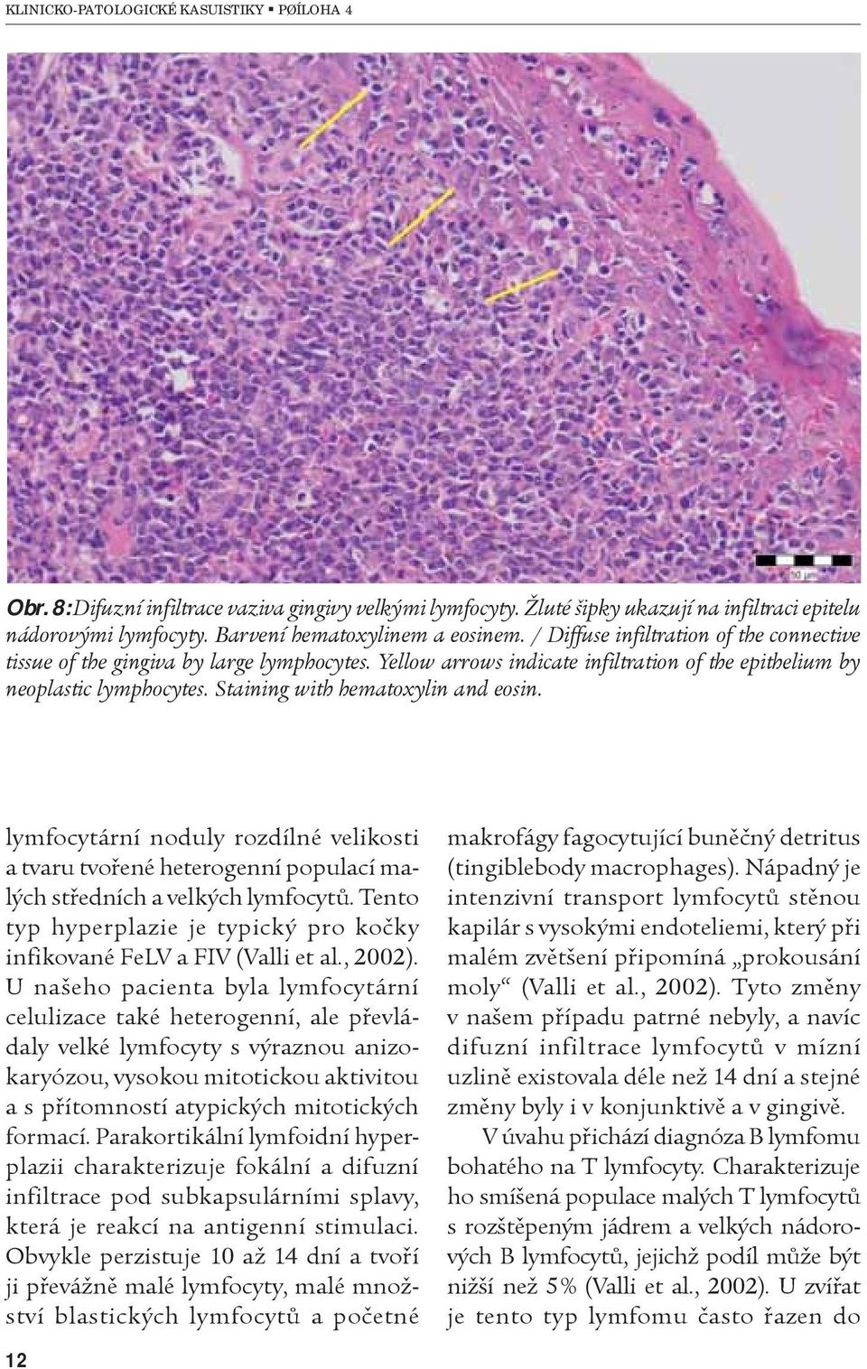 Staining with hematoxylin and eosin. lymfocytární noduly rozdílné velikosti a tvaru tvoøené heterogenní populací malých støedních a velkých lymfocytù.