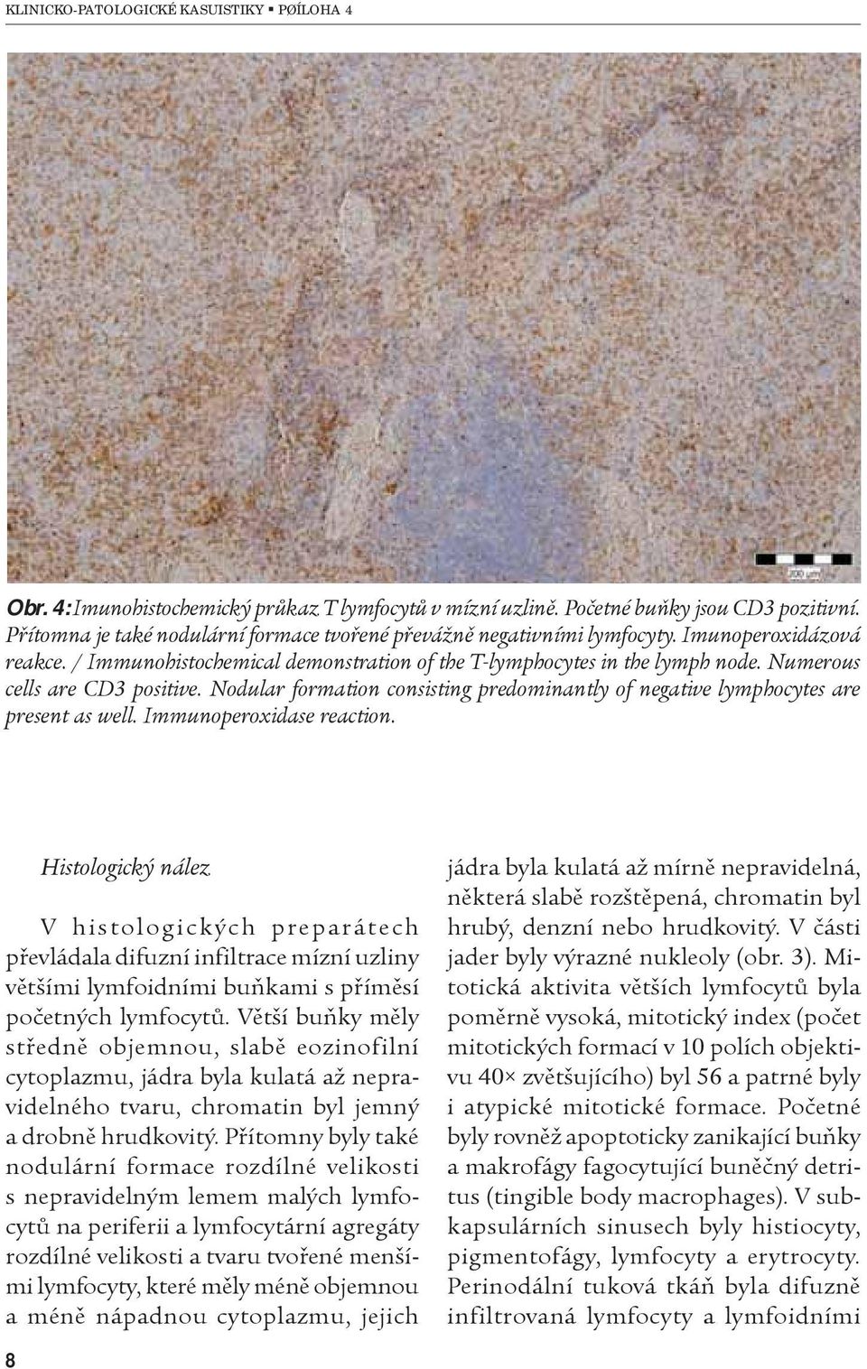 Immunoperoxidase reaction. Histologický nález V histologických preparátech pøevládala difuzní infiltrace mízní uzliny vìtšími lymfoidními buòkami s pøímìsí poèetných lymfocytù.