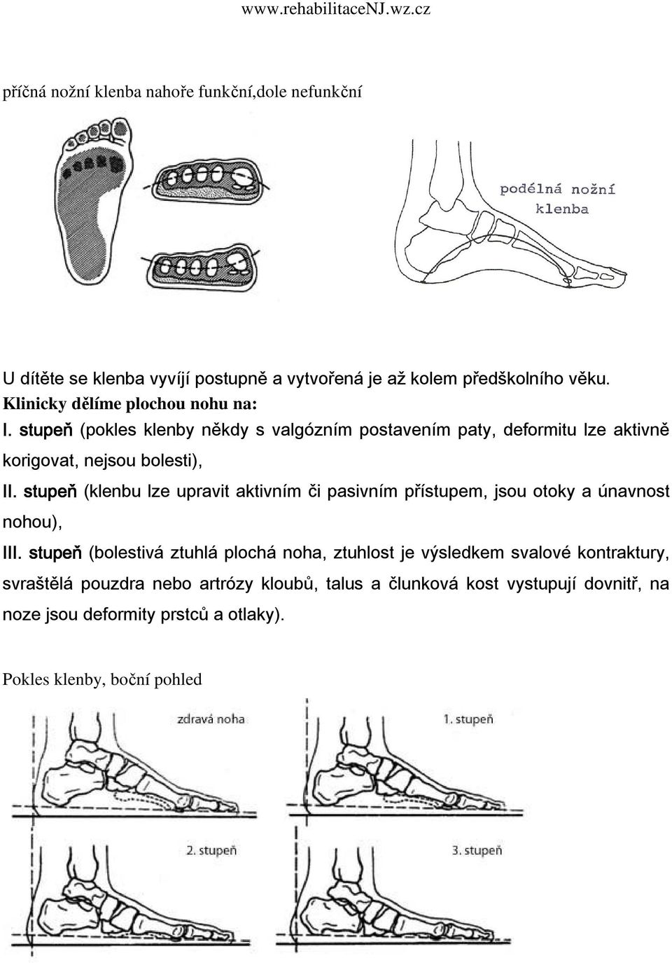 stupeň (klenbu lze upravit aktivním či pasivním přístupem, jsou otoky a únavnost nohou), III.