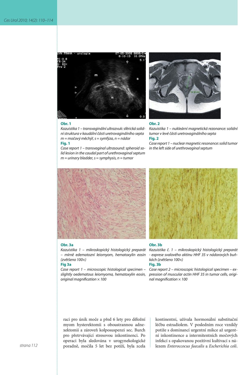 2 Kazuistika 1 nukleární magnetická rezonance: solidní tumor v levé části uretrovaginálního septa Fig.