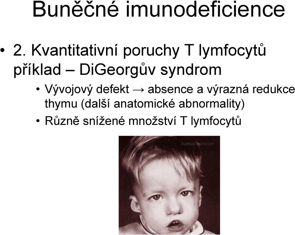 DiGeorgův syndrom Vývojový defekt absence a