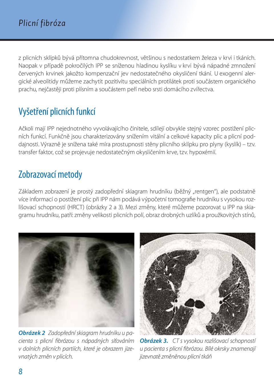 U exogenní alergické alveolitidy můžeme zachytit pozitivitu speciálních protilátek proti součástem organického prachu, nejčastěji proti plísním a součástem peří nebo srsti domácího zvířectva.