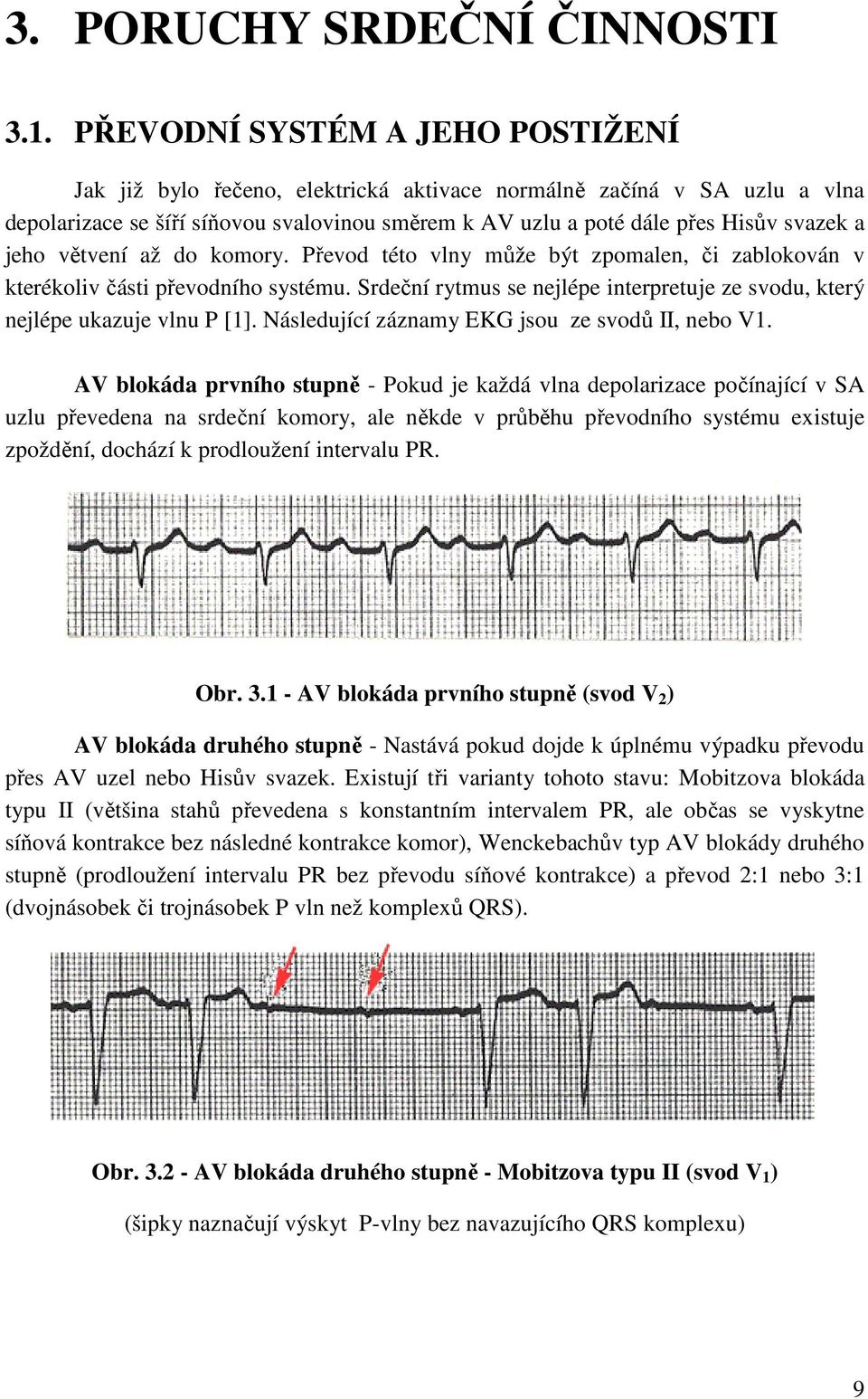 jeho větvení až do komory. Převod této vlny může být zpomalen, či zablokován v kterékoliv části převodního systému. Srdeční rytmus se nejlépe interpretuje ze svodu, který nejlépe ukazuje vlnu P [1].