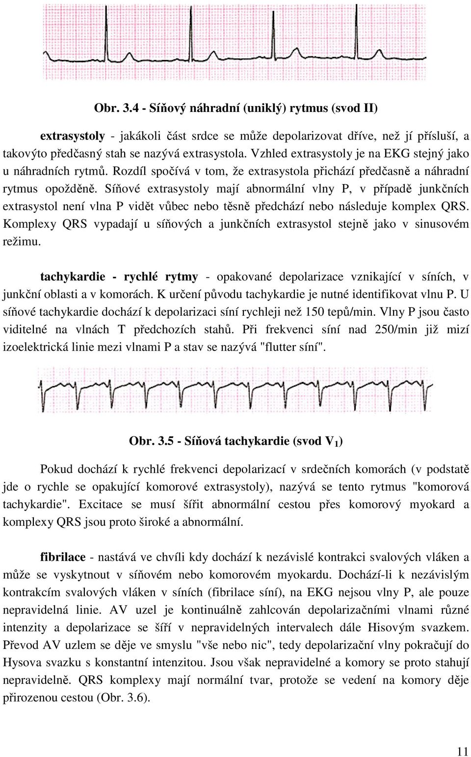 Síňové extrasystoly mají abnormální vlny P, v případě junkčních extrasystol není vlna P vidět vůbec nebo těsně předchází nebo následuje komplex QRS.