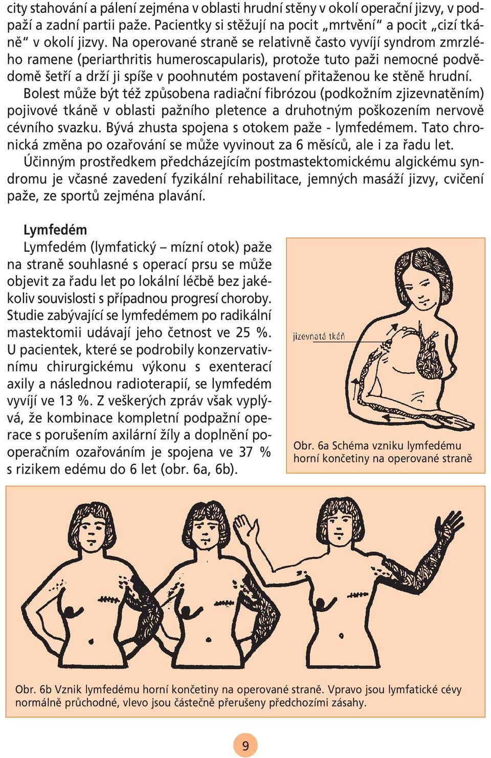 stûnû hrudní. Bolest mûïe b t téï zpûsobena radiaãní fibrózou (podkoïním zjizevnatûním) pojivové tkánû v oblasti païního pletence a druhotn m po kozením nervovû cévního svazku.