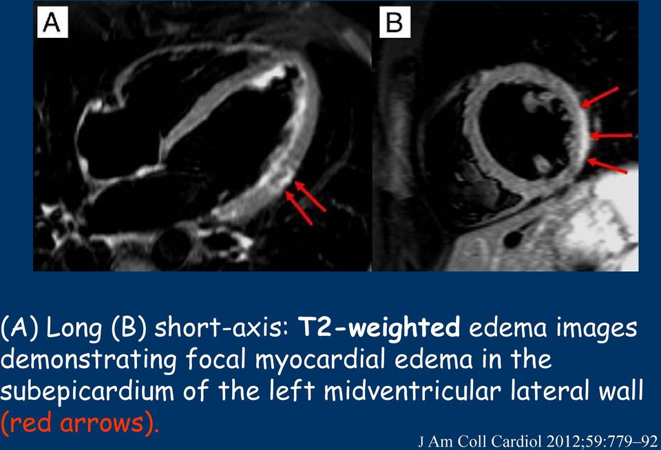 the subepicardium of the left midventricular