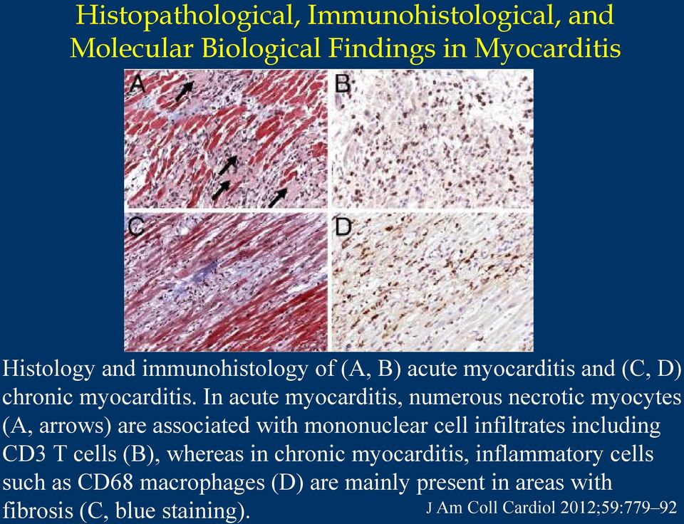 In acute myocarditis, numerous necrotic myocytes (A, arrows) are associated with mononuclear cell infiltrates including