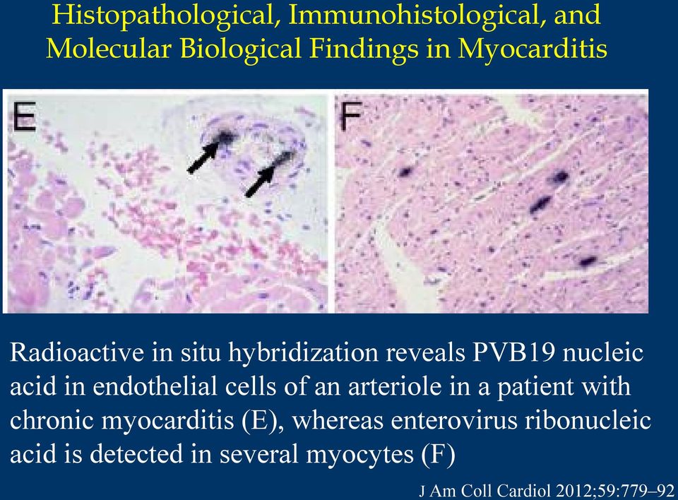 endothelial cells of an arteriole in a patient with chronic myocarditis (E),