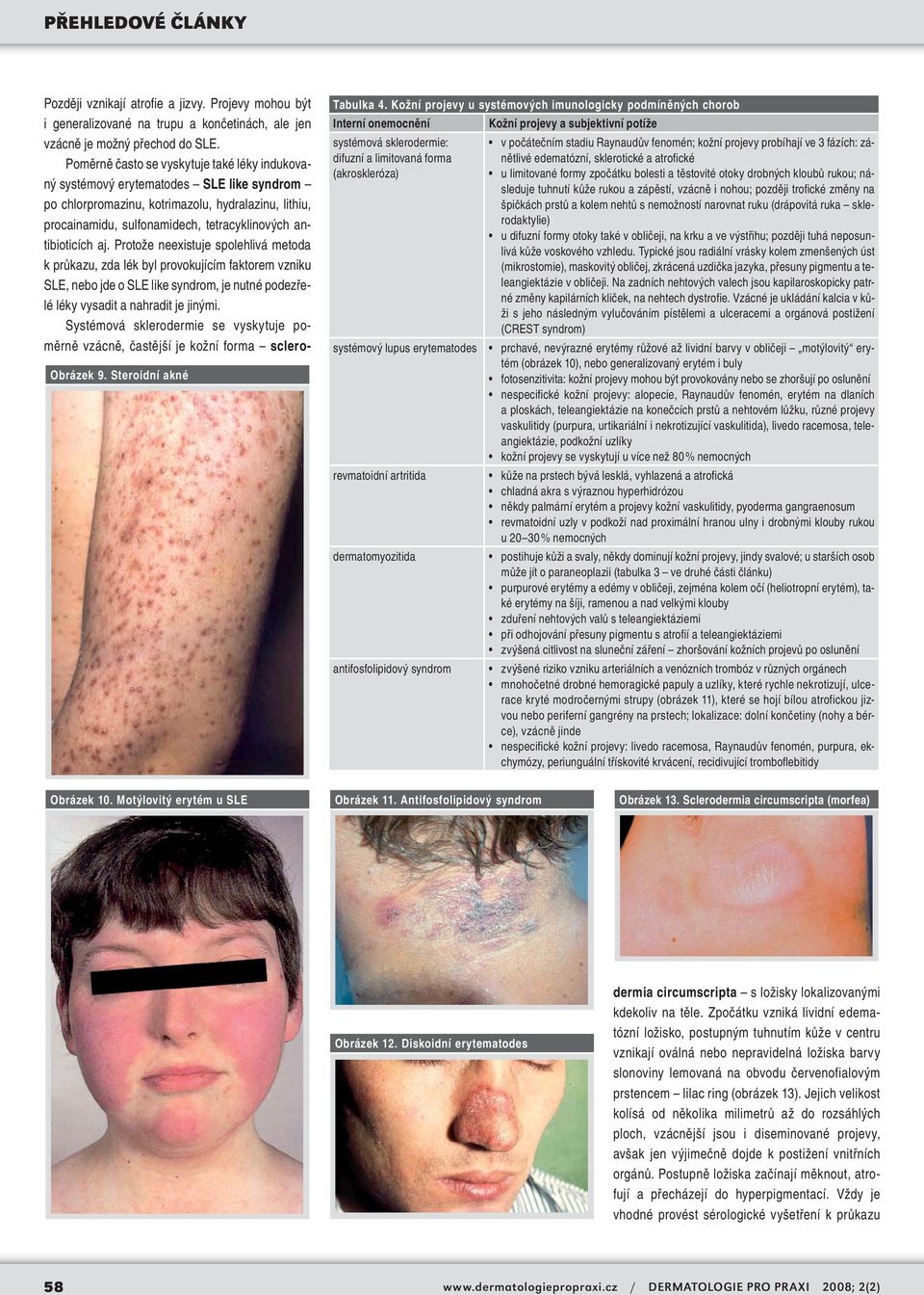 revmatoidní artritida dermatomyozitida antifosfolipidový syndrom v počátečním stadiu Raynaudův fenomén; kožní projevy probíhají ve 3 fázích: zánětlivé edematózní, sklerotické a atrofické u limitované