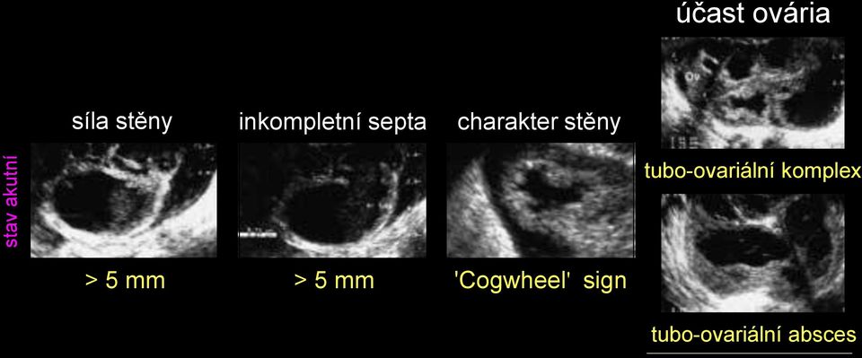 5 mm > 5 mm 'Cogwheel' sign tubo-ovariální absces bez