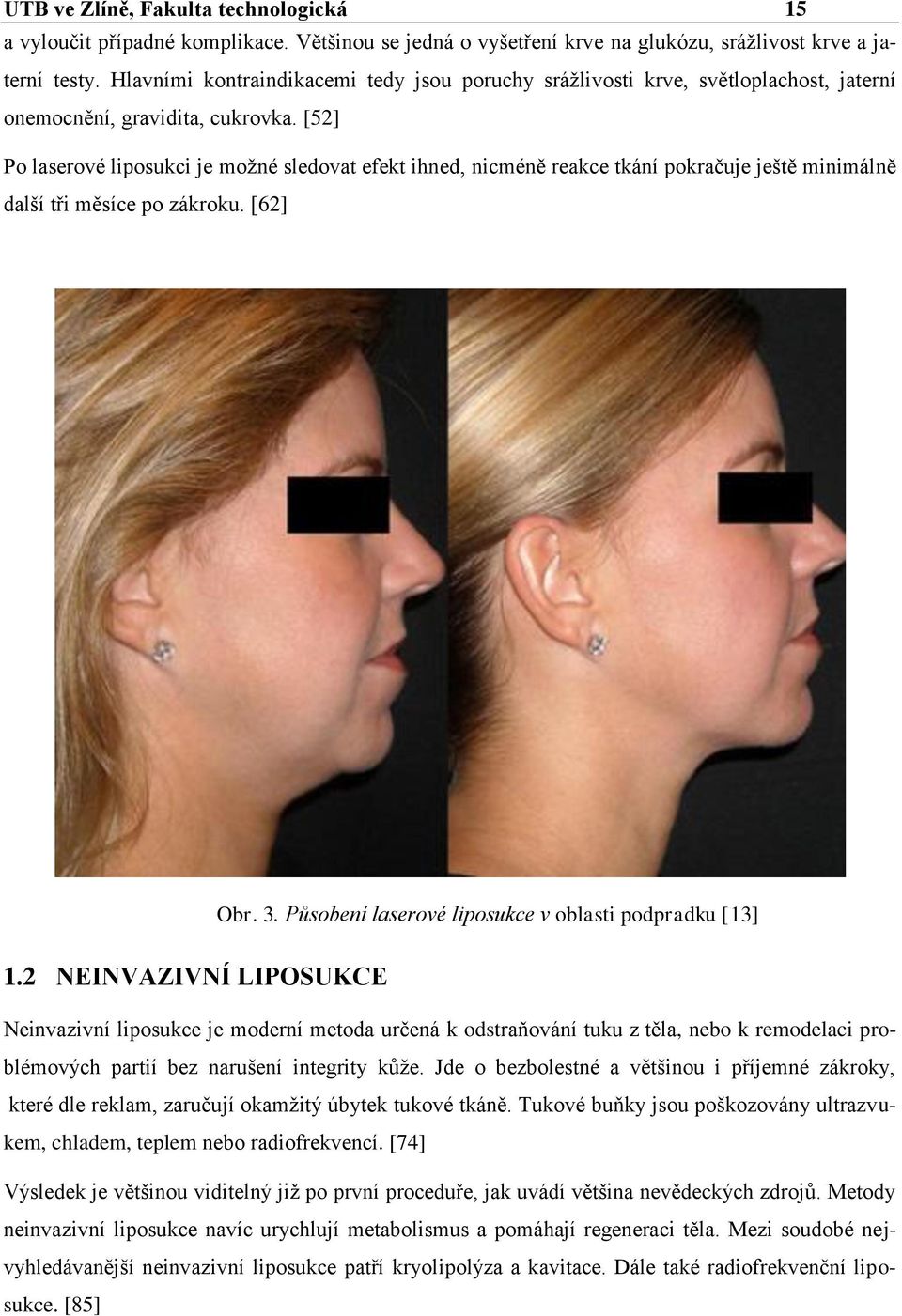 [52] Po laserové liposukci je možné sledovat efekt ihned, nicméně reakce tkání pokračuje ještě minimálně další tři měsíce po zákroku. [62] Obr. 3.
