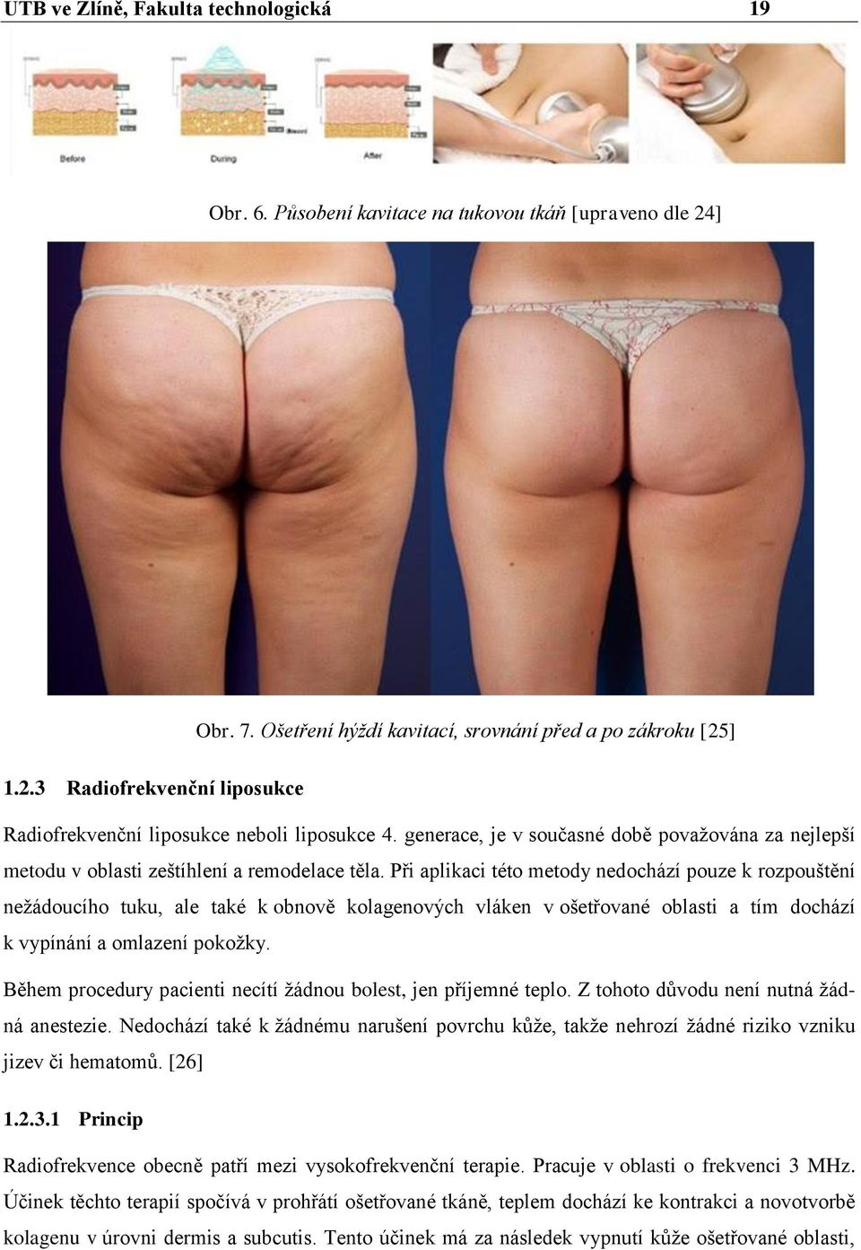 Při aplikaci této metody nedochází pouze k rozpouštění nežádoucího tuku, ale také k obnově kolagenových vláken v ošetřované oblasti a tím dochází k vypínání a omlazení pokožky.