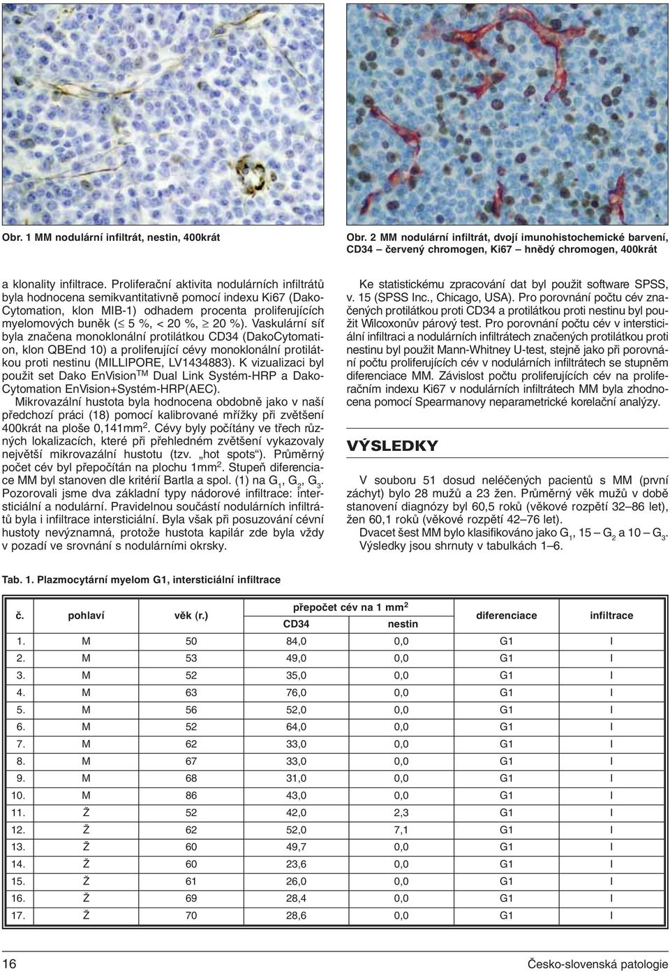 Vaskulární síť byla značena monoklonální protilátkou (DakoCytomation, klon QBEnd 10) a proliferující cévy monoklonální protilátkou proti u (MILLIPORE, LV1434883).