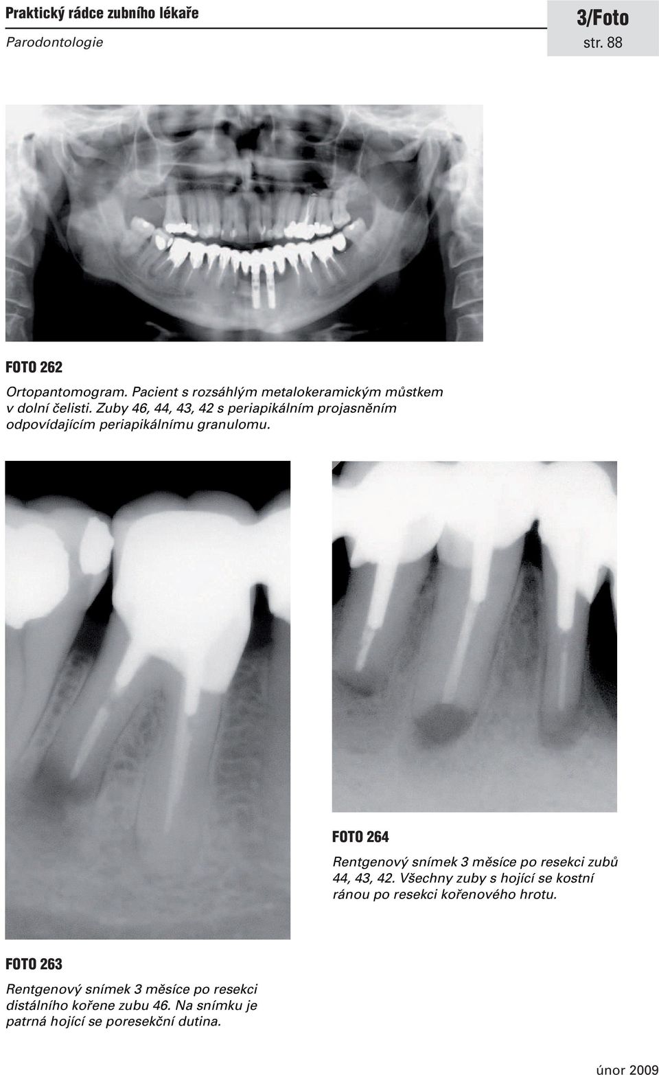 FOTO 264 Rentgenový snímek 3 měsíce po resekci zubů 44, 43, 42.