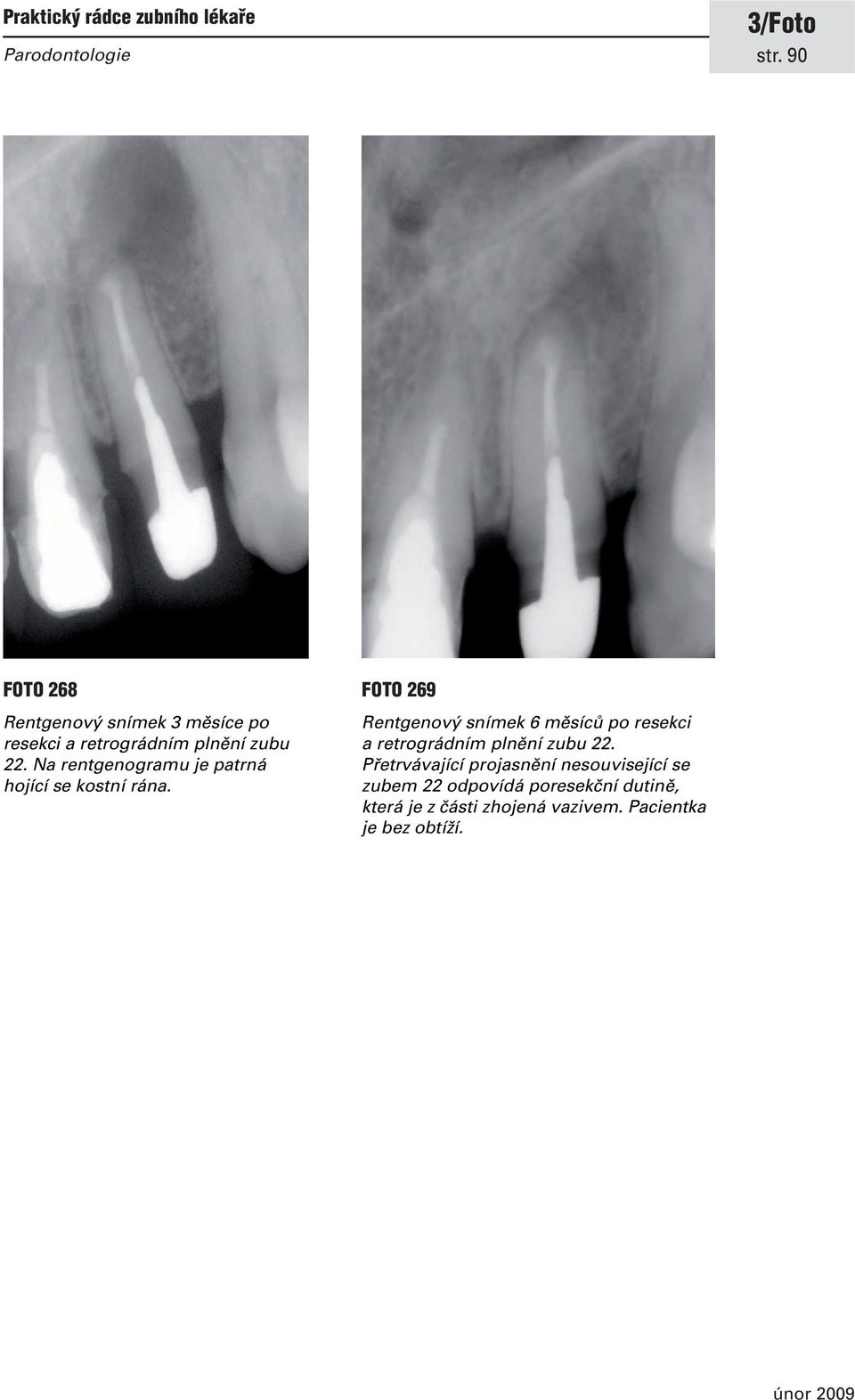 FOTO 269 Rentgenový snímek 6 měsíců po resekci a retrográdním plnění zubu 22.