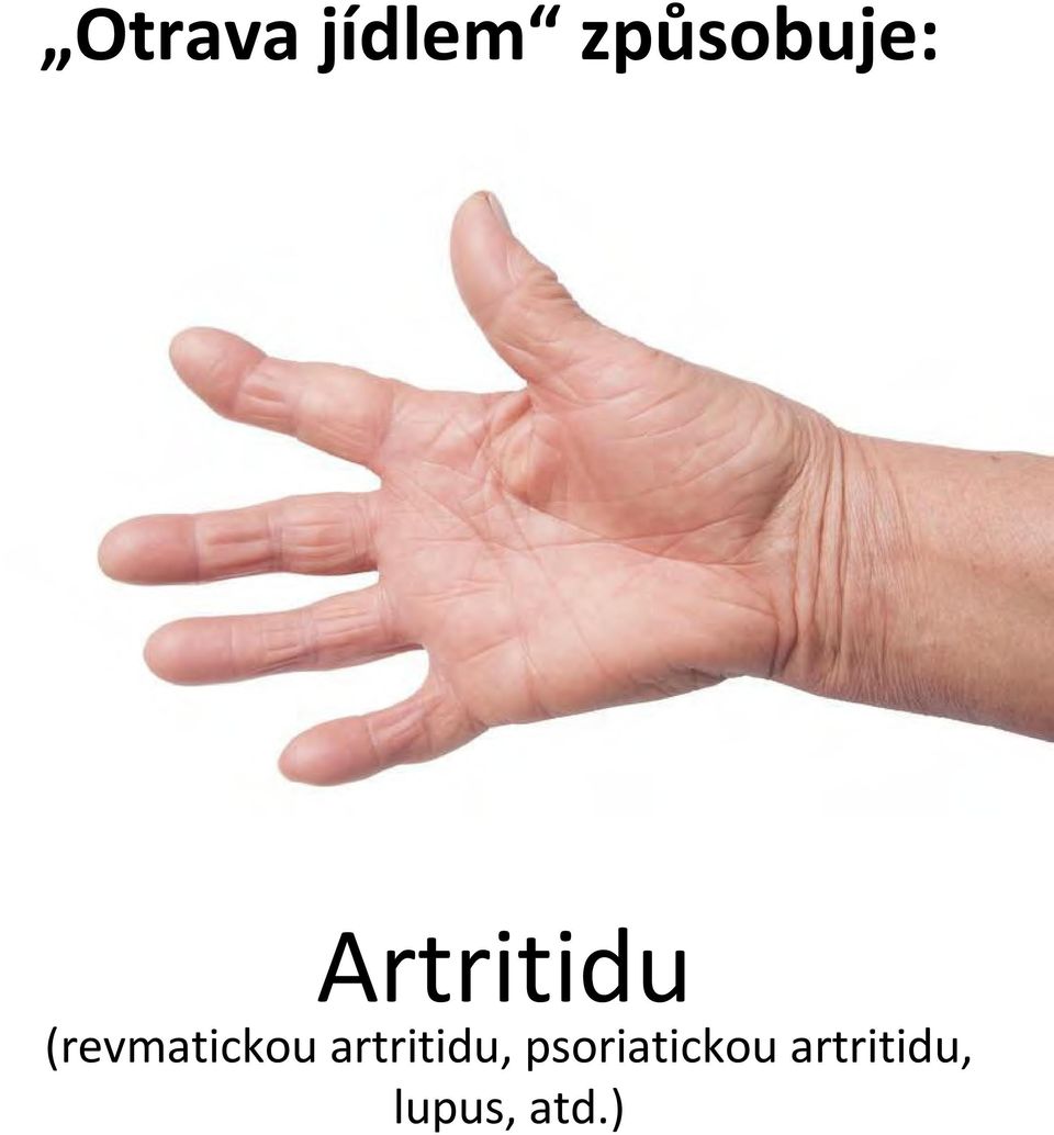 (revmatickou artritidu,