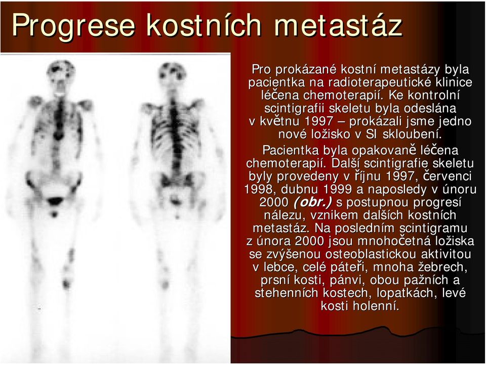 . Další scintigrafie skeletu byly provedeny v říjnu 1997, červenci 1998, dubnu 1999 a naposledy v únoru 2000 (obr.