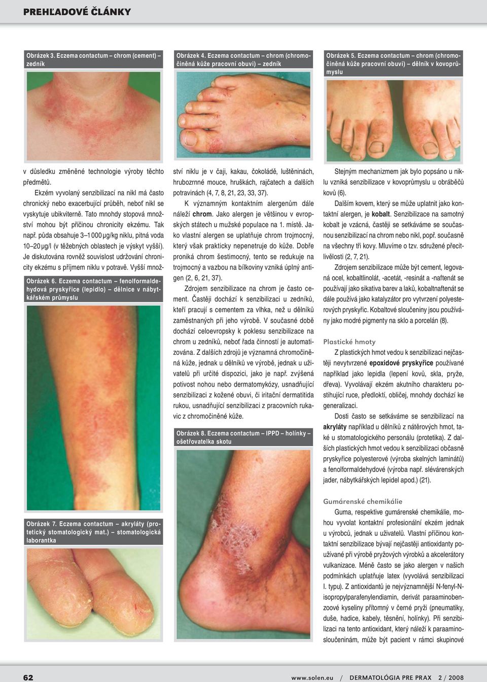 Eczema contactum fenolformaldehydová pryskyřice (lepidlo) dělnice v nábytkářském průmyslu v důsledku změněné technologie výroby těchto předmětů.