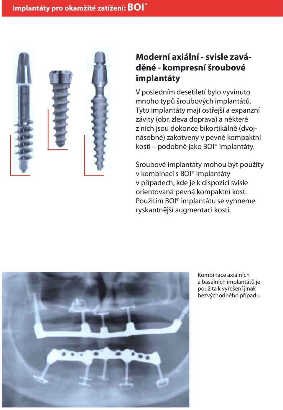 zleva doprava) a některé z nich jsou dokonce bikortikálně (dvojnásobně) zakotveny v pevné kompaktní kosti podobně jako BOI implantáty.