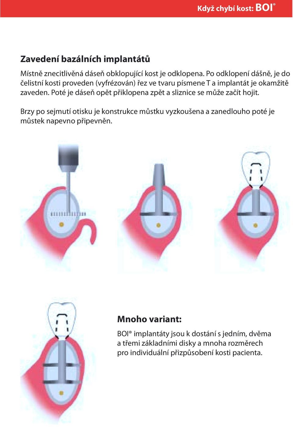 Poté je dáseň opět přiklopena zpět a sliznice se může začít hojit.