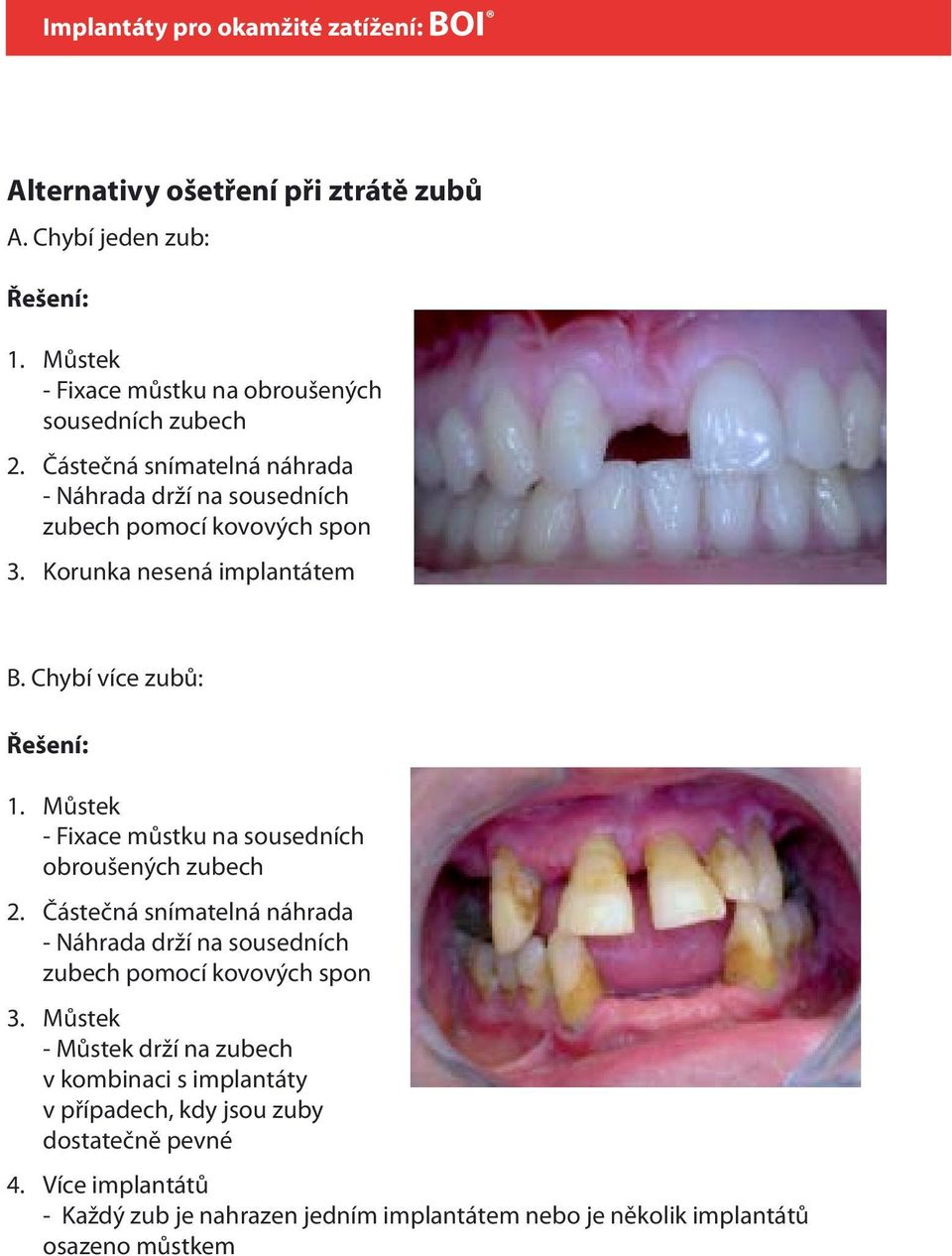 implantátem B. Chybí více zubů: Řešení: 1. 2. 3. 4.