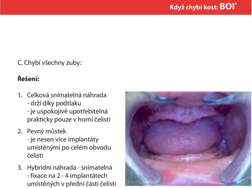 prakticky pouze v horní čelisti Pevný můstek - je nesen více implantáty umístěnými