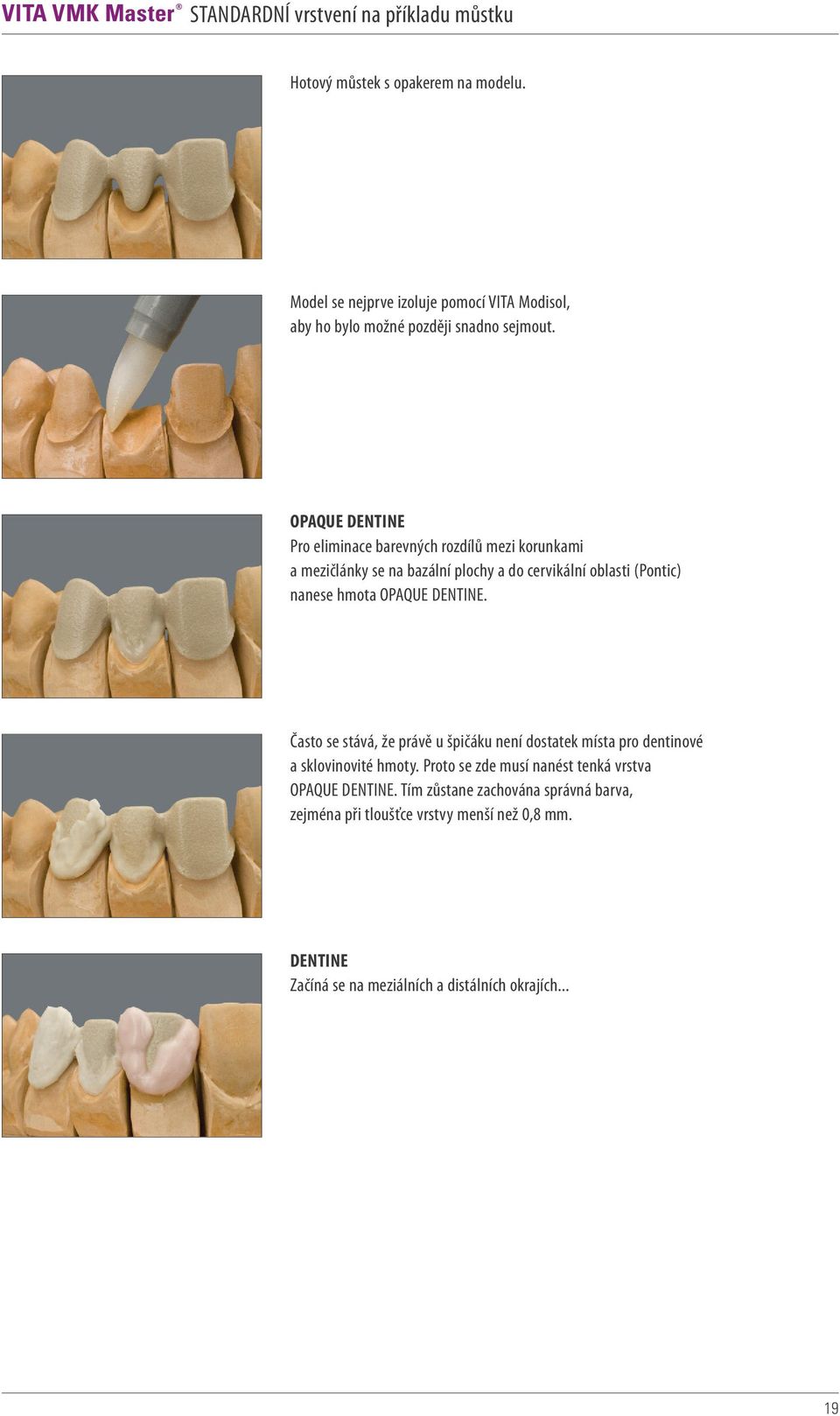 OPAQUE DENTINE Pro eliminace barevných rozdílů mezi korunkami a mezičlánky se na bazální plochy a do cervikální oblasti (Pontic) nanese hmota OPAQUE