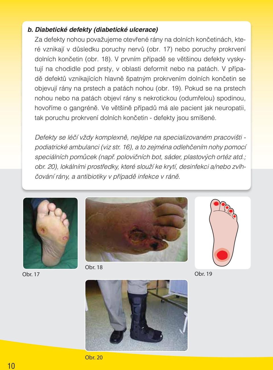 V případě defektů vznikajících hlavně špatným prokrvením dolních končetin se objevují rány na prstech a patách nohou (obr. 19).