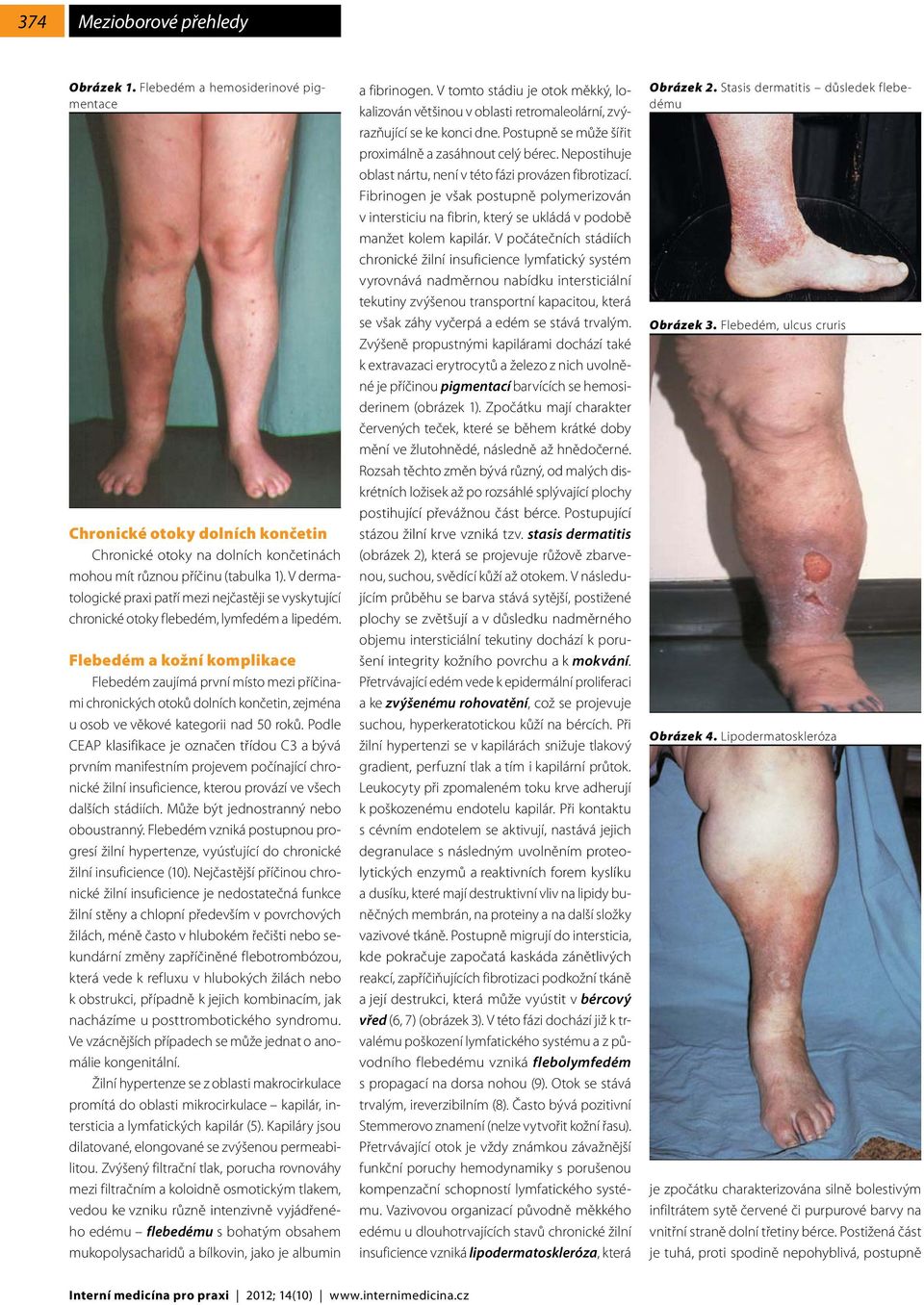 Flebedém a kožní komplikace Flebedém zaujímá první místo mezi příčinami chronických otoků dolních končetin, zejména u osob ve věkové kategorii nad 50 roků.