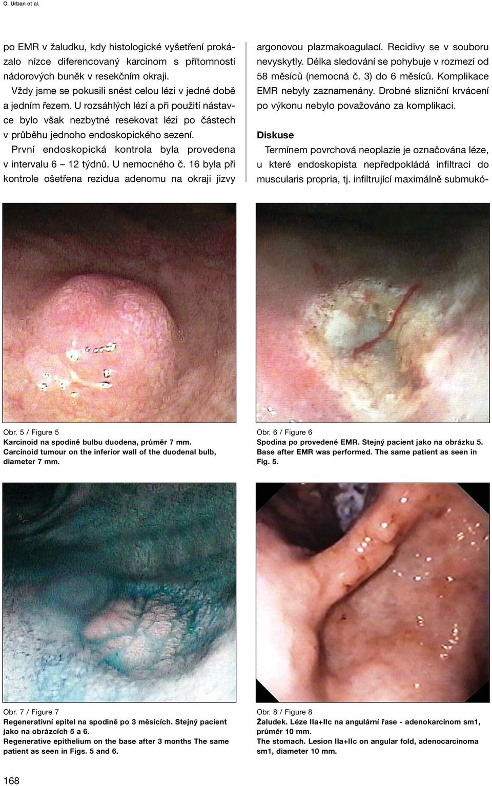 První endoskopická kontrola byla provedena v intervalu 6 12 týdnů. U nemocného č. 16 byla při kontrole ošetřena rezidua adenomu na okraji jizvy argonovou plazmakoagulací.