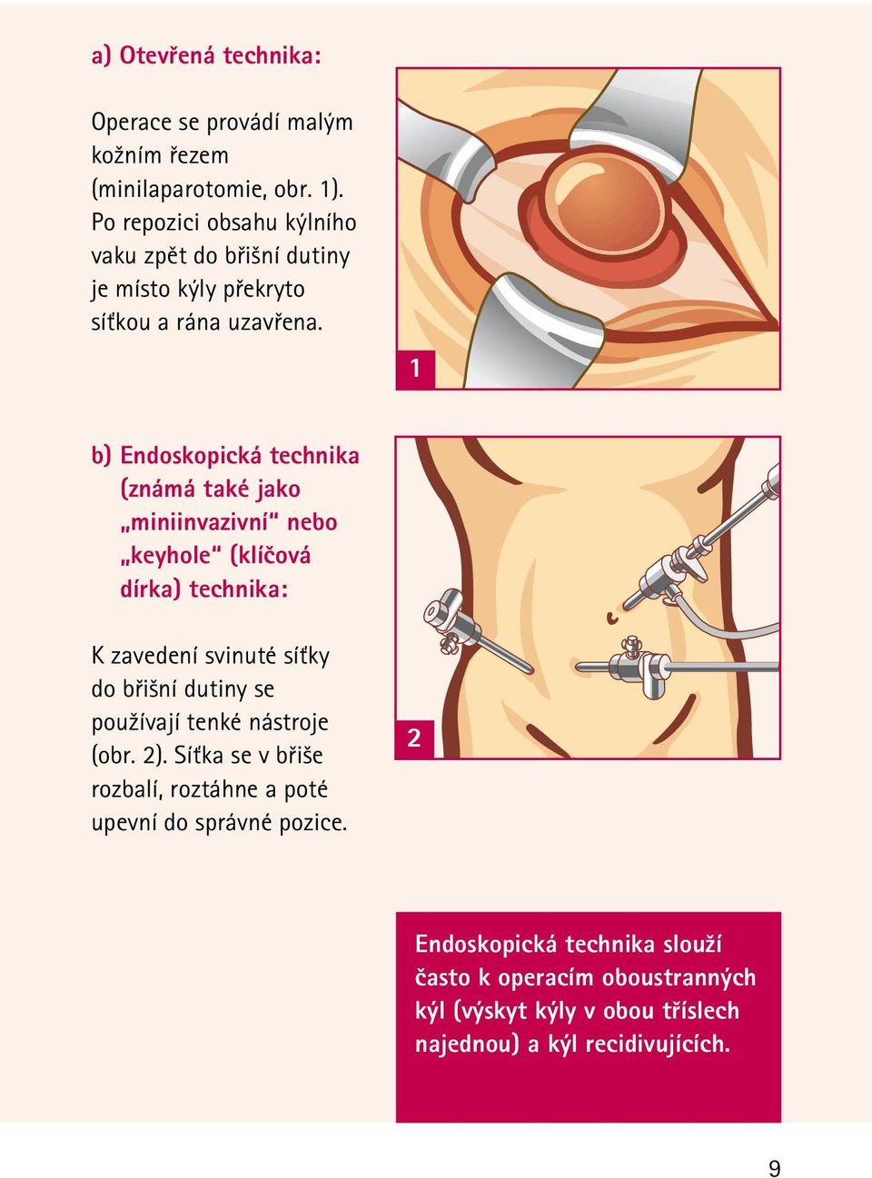 1 b) Endoskopická technika (známá také jako miniinvazivní nebo keyhole (klíčová dírka) technika: K zavedení svinuté síťky do břišní dutiny