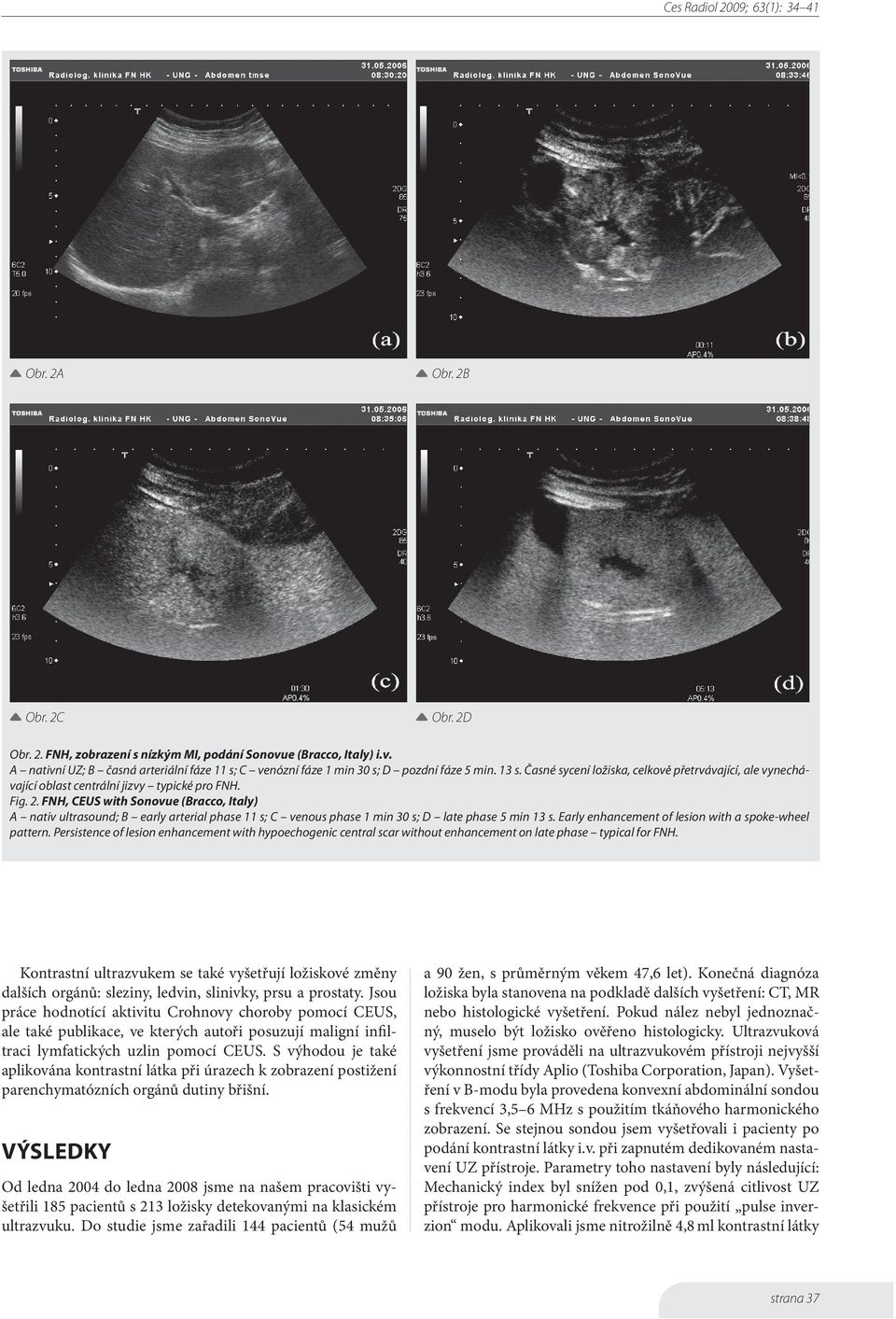 FNH, CEUS with Sonovue (Bracco, Italy) A nativ ultrasound; B early arterial phase 11 s; C venous phase 1 min 30 s; D late phase 5 min 13 s. Early enhancement of lesion with a spoke-wheel pattern.