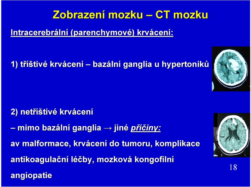 krvácen cení mimo bazáln lní ganglia jiné příčiny: av malformace ace, krvácen