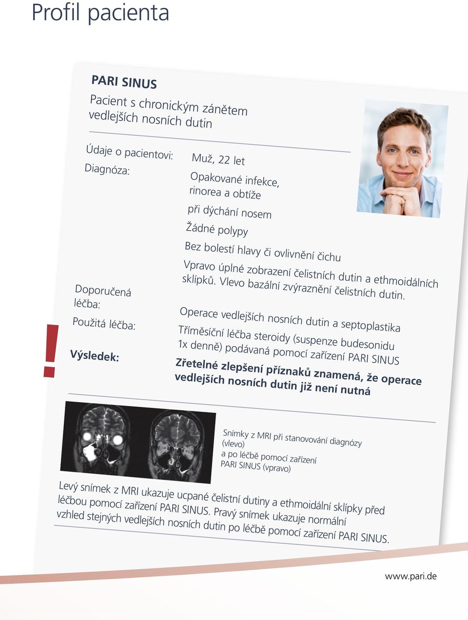 ! Doporučená léčba: Operace vedlejších nosních dutin a septoplastika Použitá léčba: Tříměsíční léčba steroidy (suspenze budesonidu 1x denně) podávaná pomocí zařízení PARI SINUS Výsledek: Zřetelné