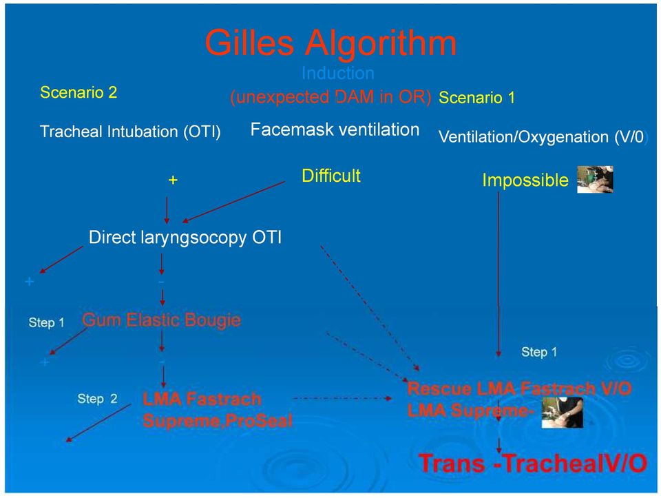 Impossible Direct laryngsocopy OTI - + Step 1 Gum Elastic Bougie + Step 2 + LMA