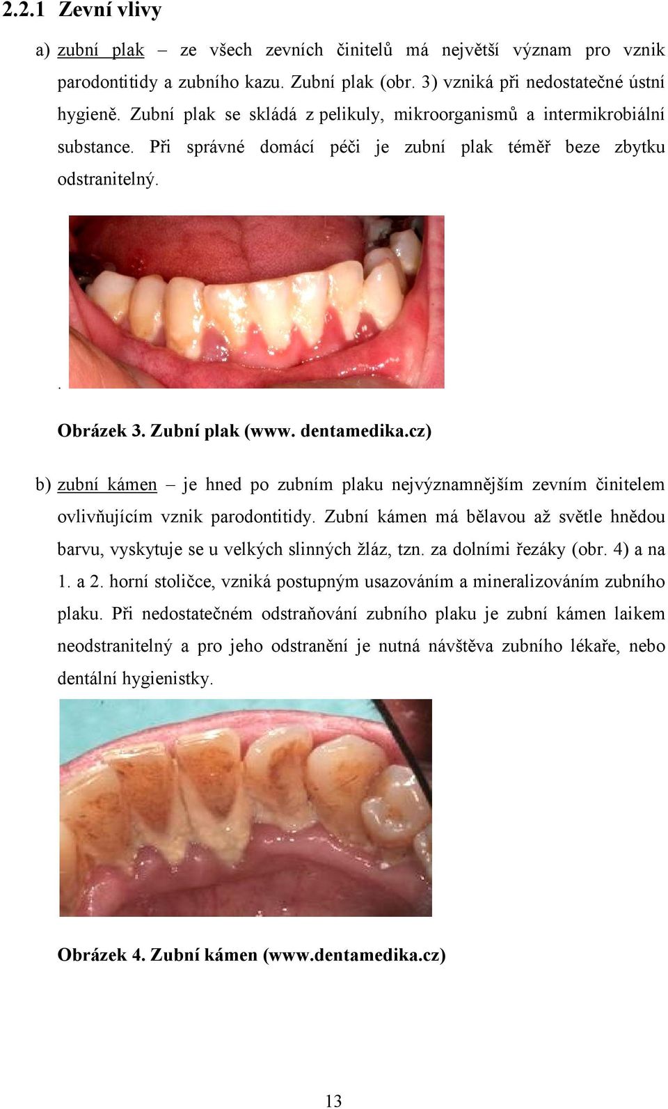 cz) b) zubní kámen je hned po zubním plaku nejvýznamnějším zevním činitelem ovlivňujícím vznik parodontitidy. Zubní kámen má bělavou až světle hnědou barvu, vyskytuje se u velkých slinných žláz, tzn.