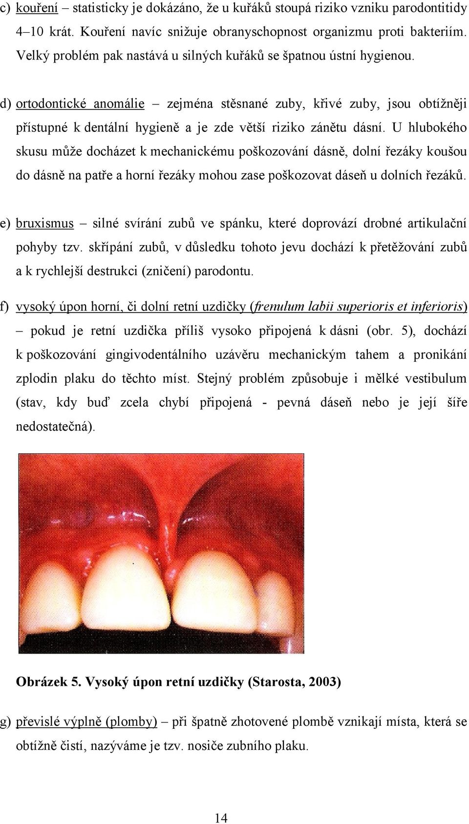 d) ortodontické anomálie zejména stěsnané zuby, křivé zuby, jsou obtížněji přístupné k dentální hygieně a je zde větší riziko zánětu dásní.