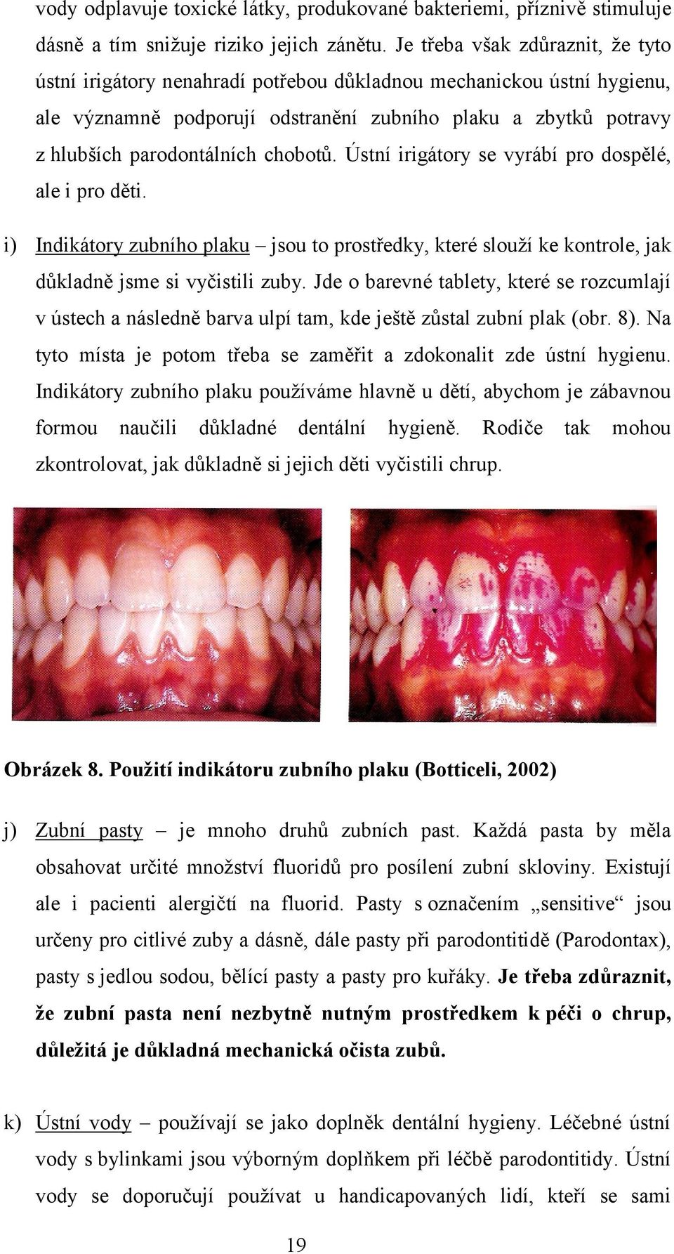 chobotů. Ústní irigátory se vyrábí pro dospělé, ale i pro děti. i) Indikátory zubního plaku jsou to prostředky, které slouží ke kontrole, jak důkladně jsme si vyčistili zuby.